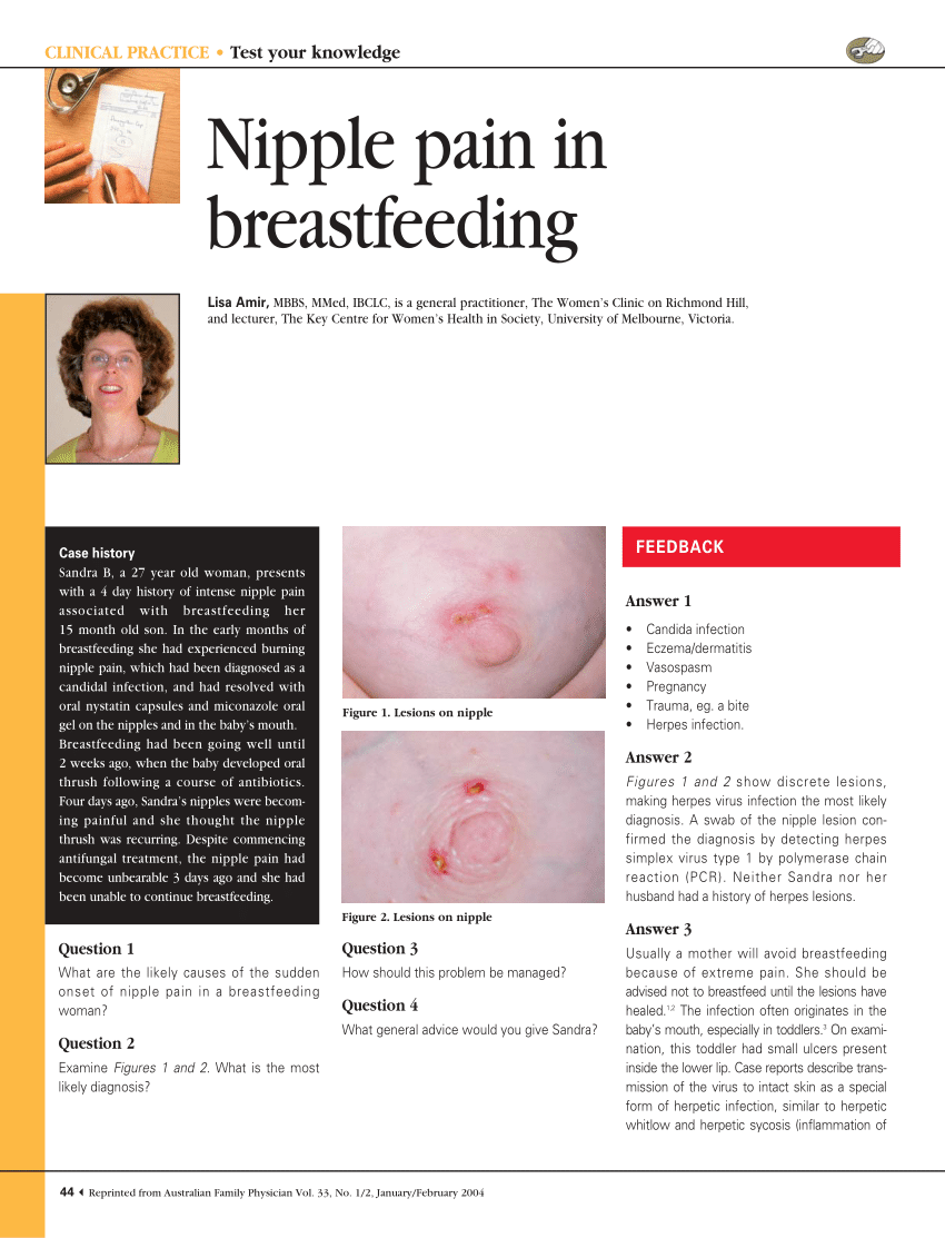 Breastfeeding Sore Nipple Pain Relief & Treatment