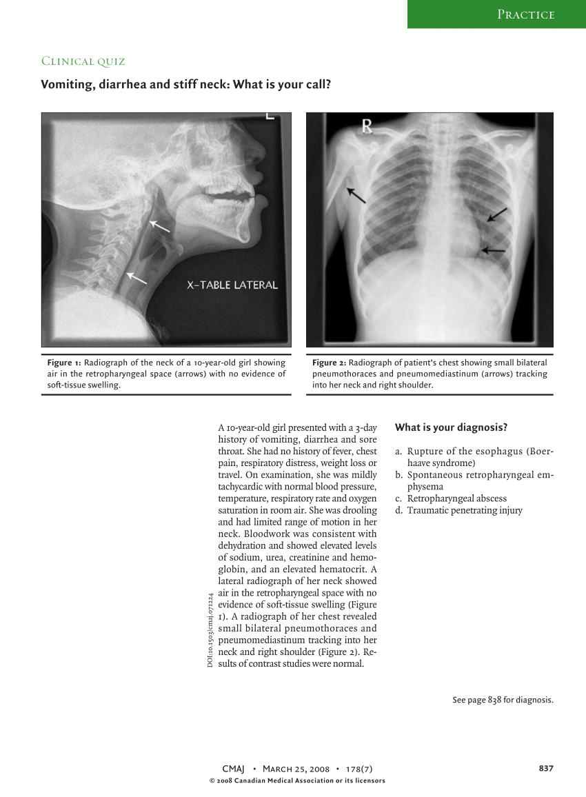 pdf-vomiting-diarrhea-and-stiff-neck-what-is-your-call