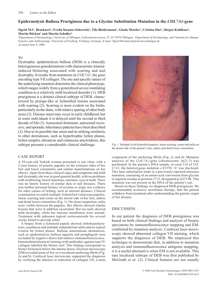 Pdf Epidermolysis Bullosa Pruriginosa Due To A Glycine Substitution Mutation In The Col7a1 Gene 6747