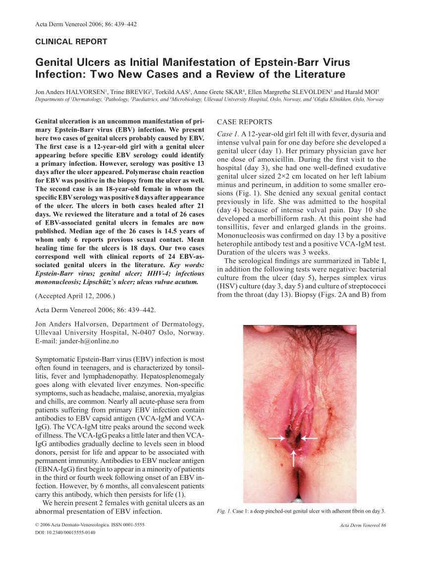 human papillomavirus genital ulcers minocycline dose for confluent and reticulated papillomatosis