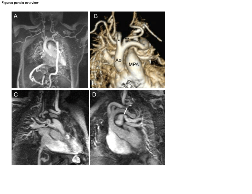 Pdf Cardiovascular Findings In Arterial Tortuosity Syndrome