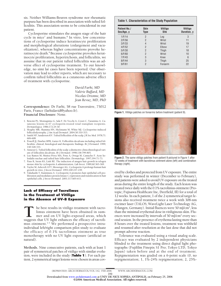 Vitiligo al penisului glandelor și al prepuțului: tratament în New York
