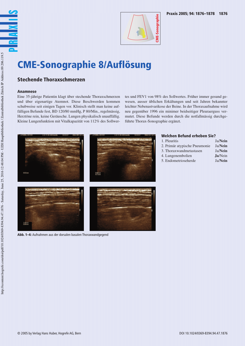 Pdf Stabbing Thoracic Pain Multiple Lung Embolisms - 