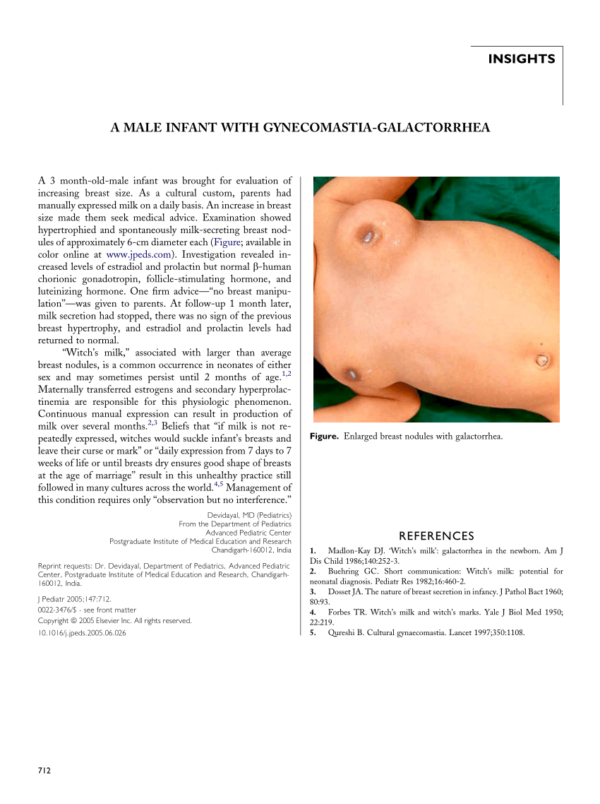 PDF A Male Infant with Gynecomastia Galactorrhea