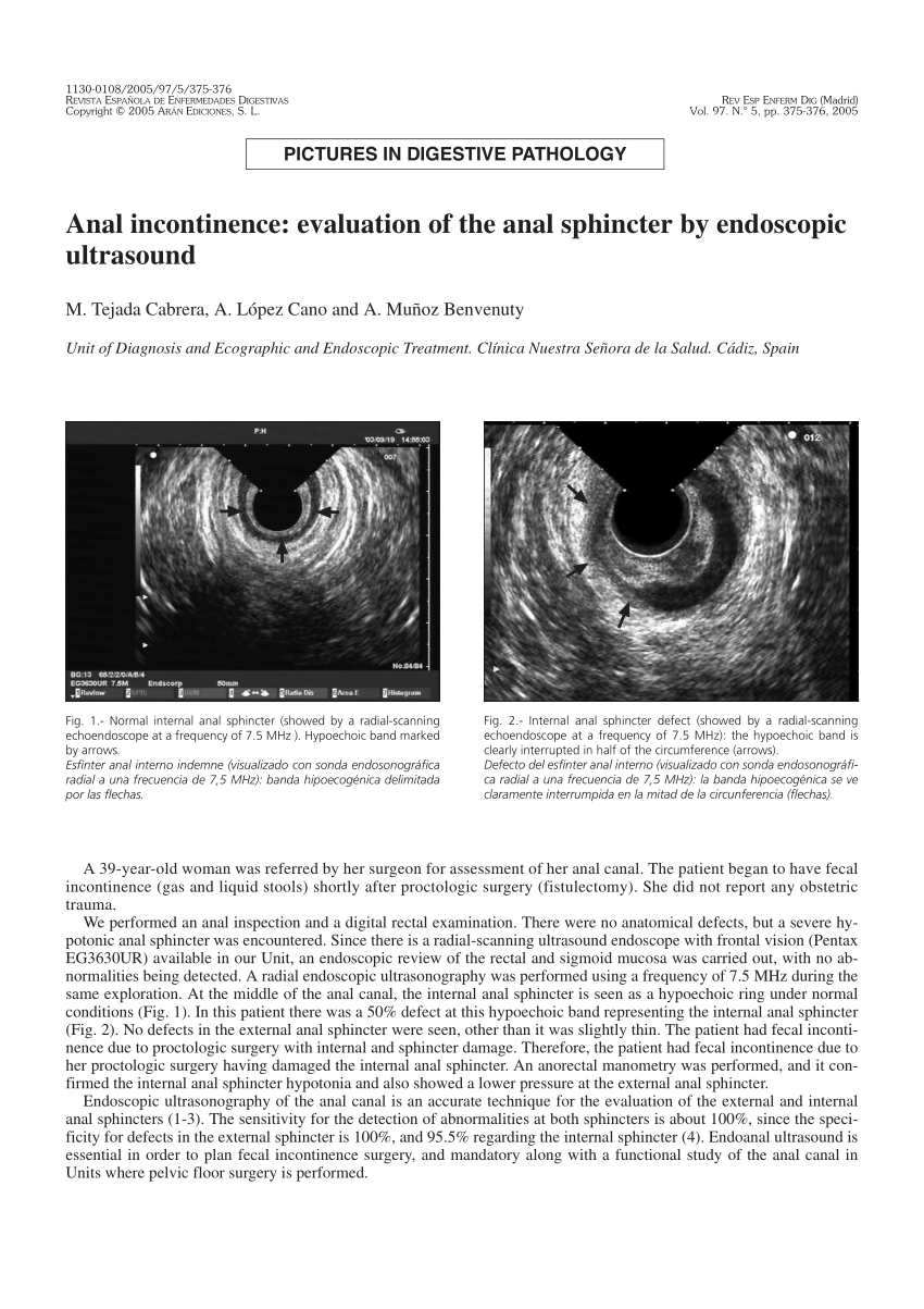 Pdf Anal Incontinence Evaluation Of The Anal Sphincter By Endoscopic Ultrasound 