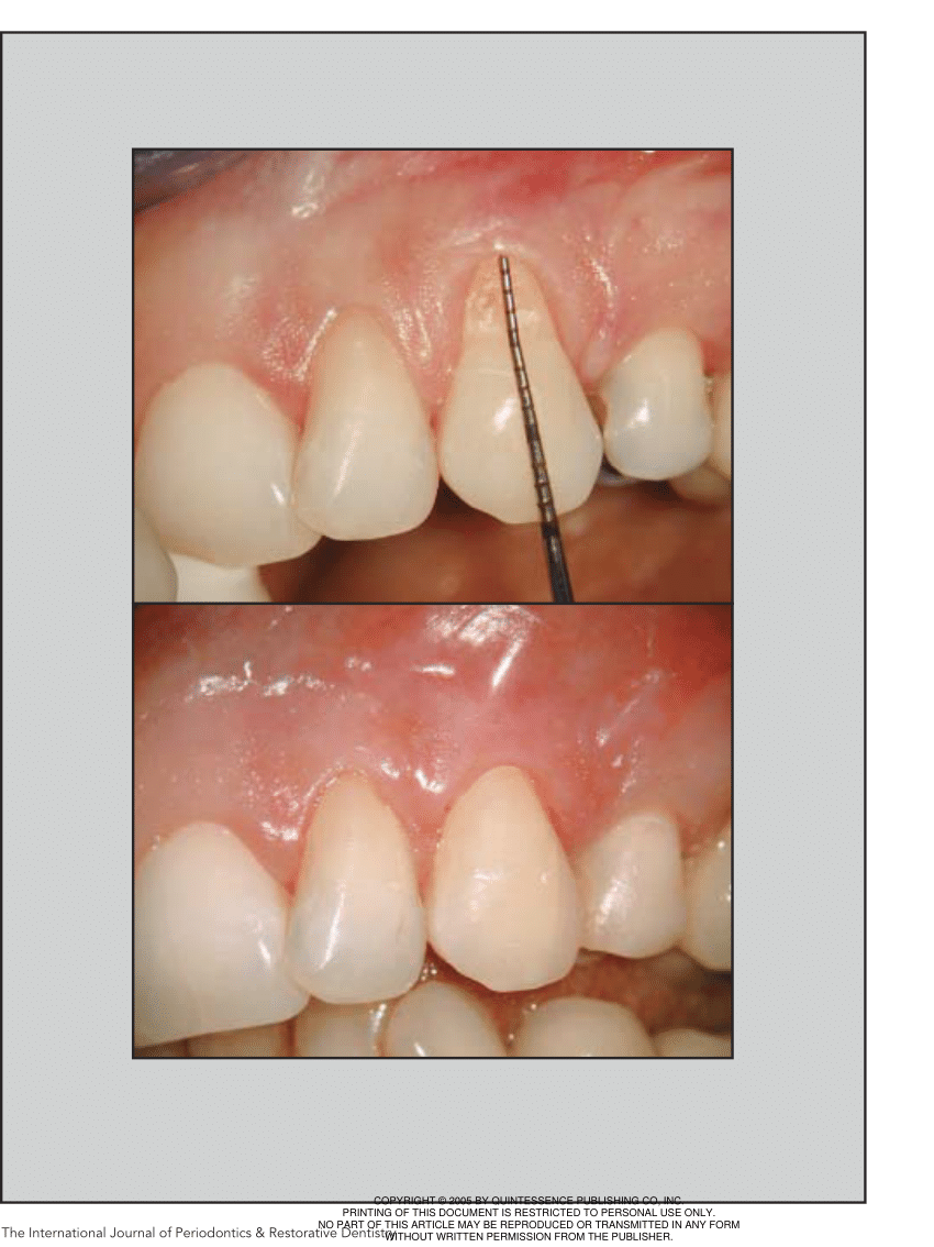 Pdf Microsurgical Treatment Of Gingival Recession A Controlled