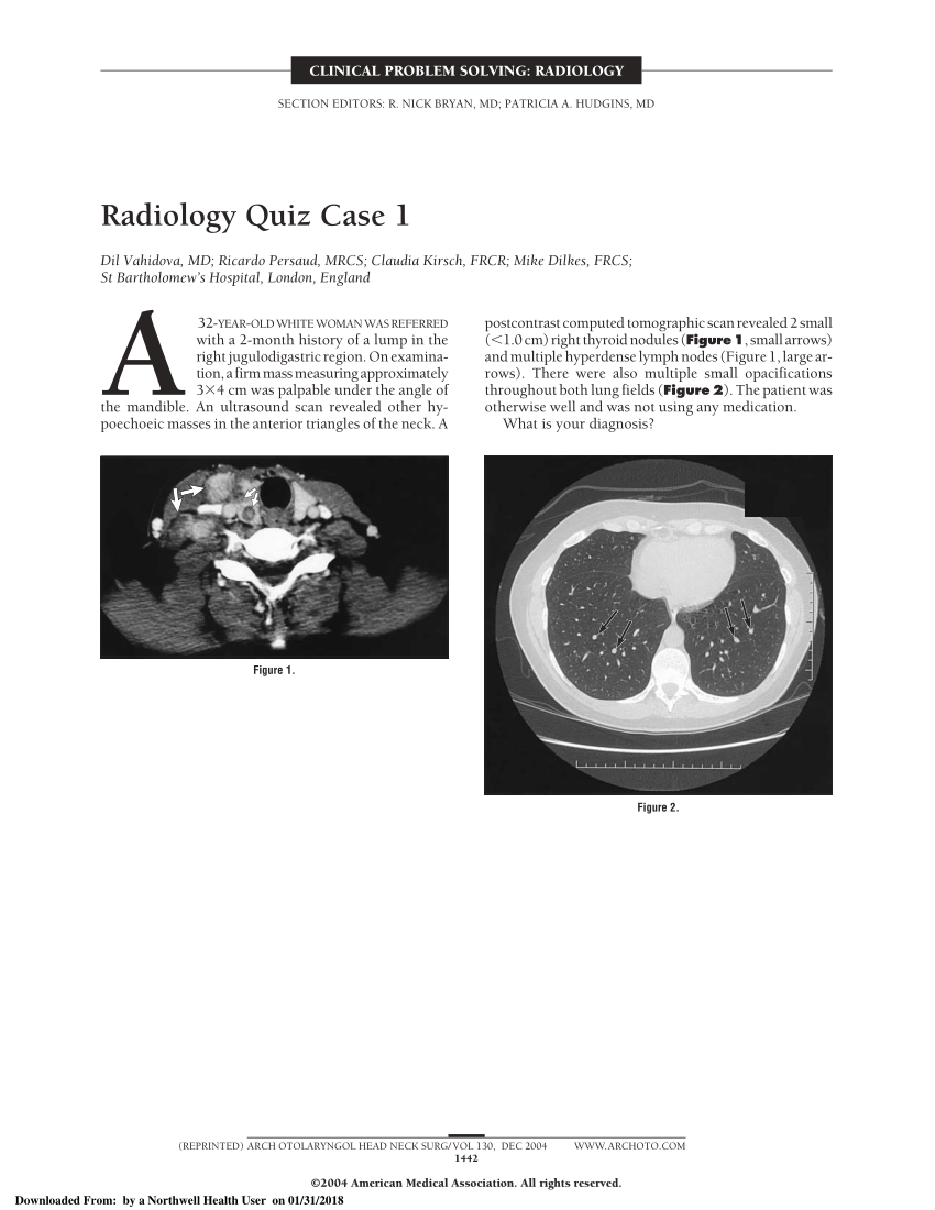 Papillary Thyroid Carcinoma Medicine Notes Thorax Ele