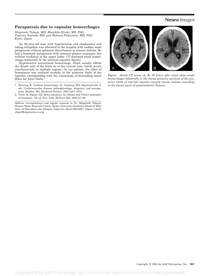 pdf-paraparesis-due-to-capsular-hemorrhages