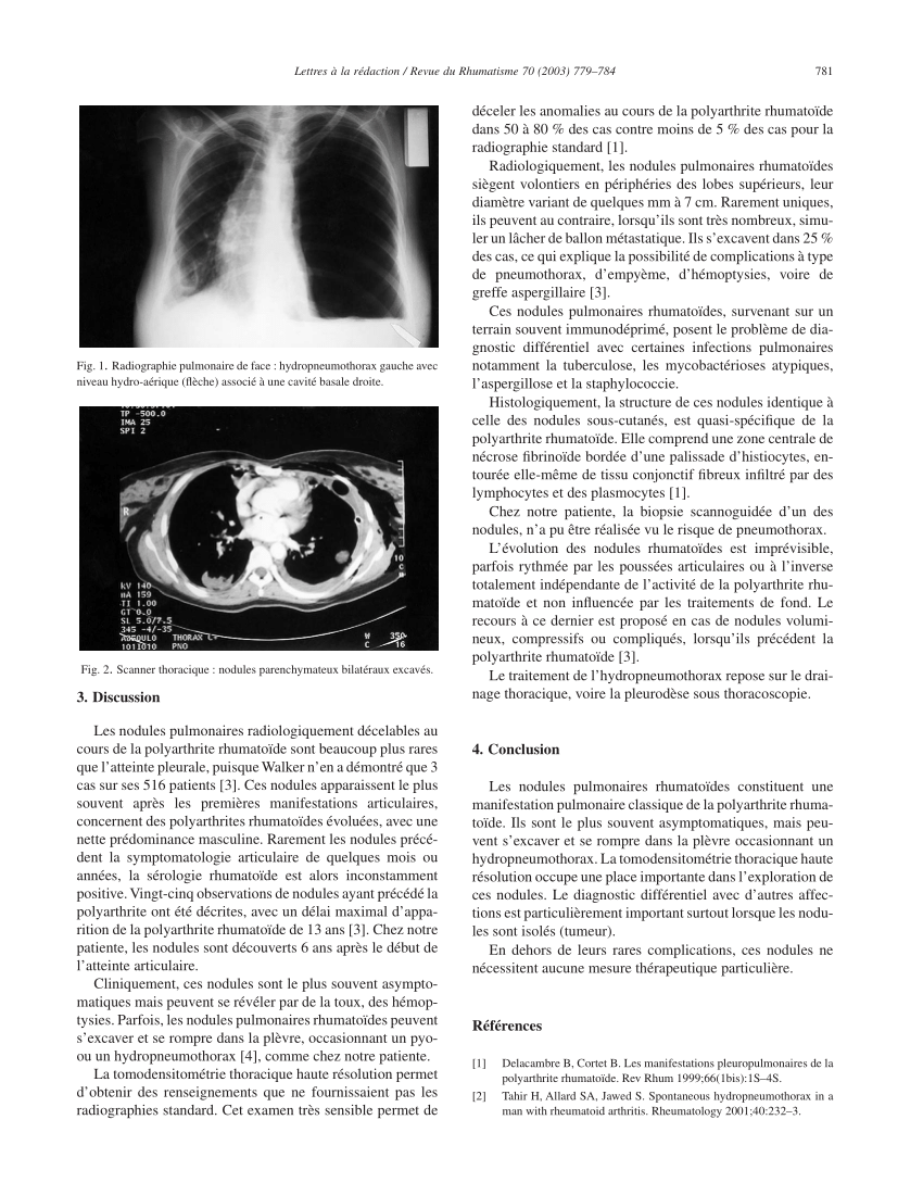 radiographie pulmonaire de face hydropneumothorax gauche avec niveau download scientific diagram